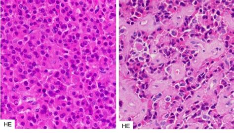 Pathology And Pathogenesis Of Pituitary Adenomas And Other Sellar