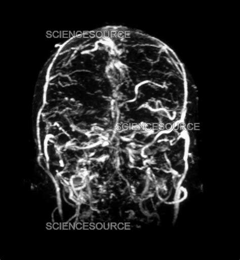 Photograph | MRI of Venogram of Dural Sinus Thrombo | Science Source Images