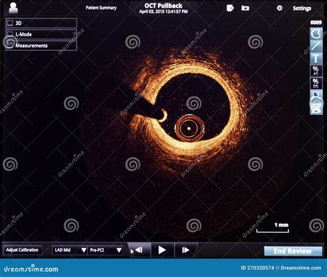 Optical Coherence Tomography Oct Image Angiography Catheter Lab