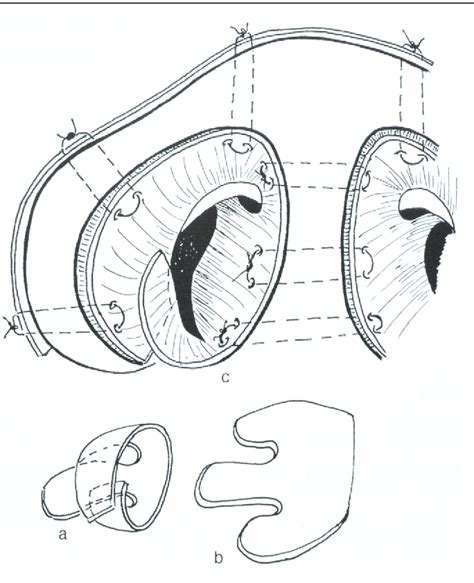 Figure 11 From Rhinoplastie De Fente Primaire Et Secondaire Semantic