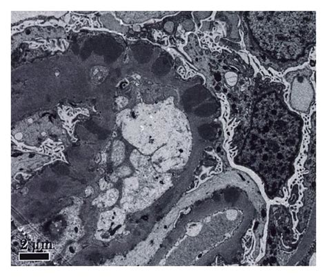 A Fibrocellular Crescent In Bowmans Space With Significant Collapse