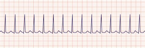 Acls Rhythm Strips Training And Interpretation