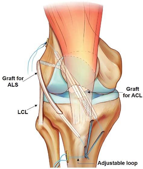 Figure 1 From Effects Of Anterolateral Structure Augmentation On The In