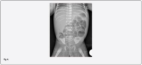 Meconium Peritonitis Antenatal Diagnosis And Management Two Case Reports