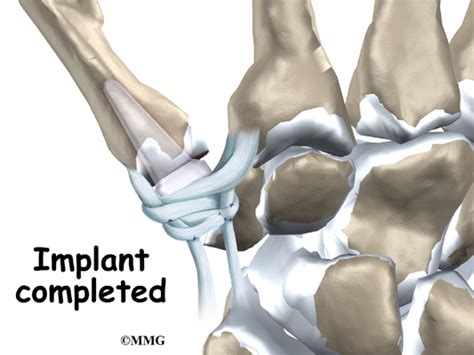 Artificial Joint Replacement of the Thumb - eOrthopod.com