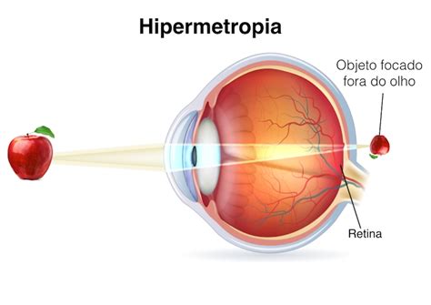 O que é uma Hipermetropia Clínica Oftalmológica Dr Rui Avelino Resende