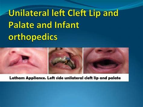 Cleft Lip And Palate Orthodontic Treatment In London On Foley Wilde