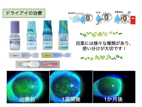 よくある目の病気｜香川県坂出市の小児眼科、一般眼科、総合内科なら「ふじみ眼科内科クリニック（旧 沖津眼科）」へ