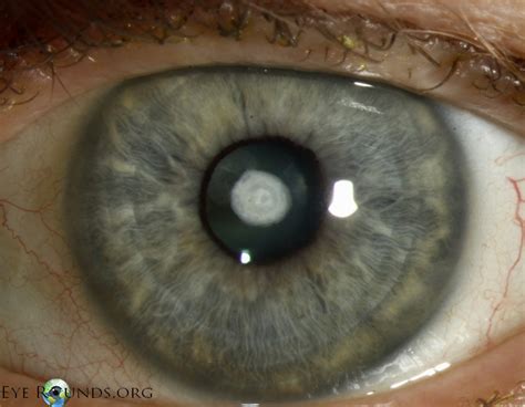 Anterior Capsular Cataract