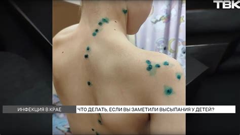 Странная сыпь появилась у детей в Красноярском крае - YouTube