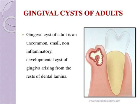 Gingival cyst of newborn /orthodontic courses by Indian dental academ…