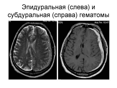 Гематомы головного мозга - online presentation
