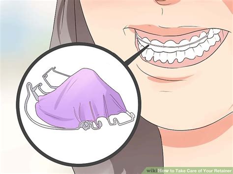 3 Ways To Take Care Of Your Retainer WikiHow