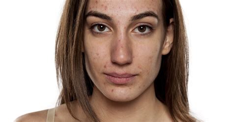 What Causes Adult Acne And How To Treat It Australian Skin Clinics