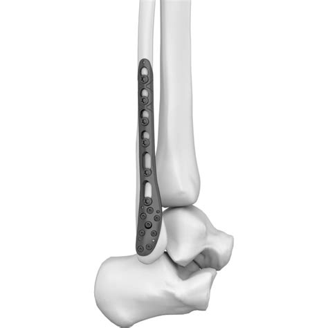 Distal Lateral Fibular Locking Plate Boneunion Medical