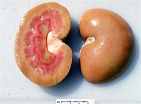 29 Pathology Of The Glomerulus And Tubules And Nephrotic Syndrome
