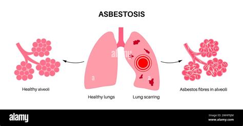 Asbestosis Lung Disease Illustration Stock Photo Alamy