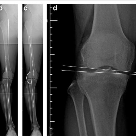 Radiographic Evaluation Bilateral Standing Whole Leg Radiographs A