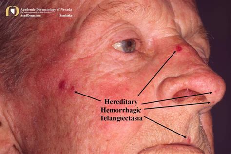 Hereditary Hemorrhagic Telangiectasia Causes Symptoms Diagnosis