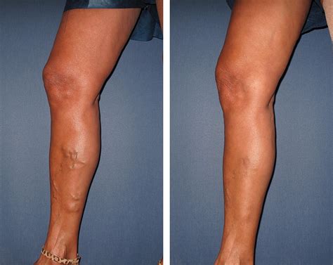 Before After Vein Treatment Ez Veins Orange County Ca Vein Specialists