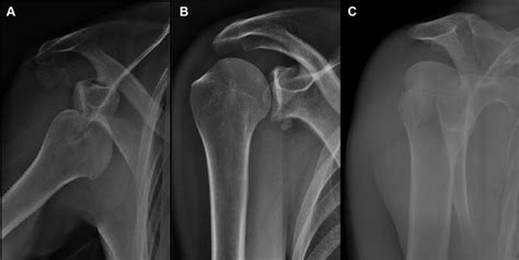 A Anteroposterior Radiography Showing Right Anterior Shoulder