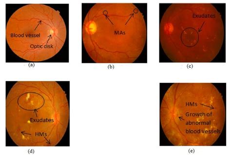 a) Normal retina b) Mild NPDR c) Moderate NPDR d) Severe NPDR d) PDR ...