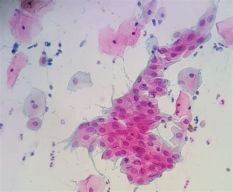 Metaplasia de células escamosas Citología cervicovaginal d Flickr