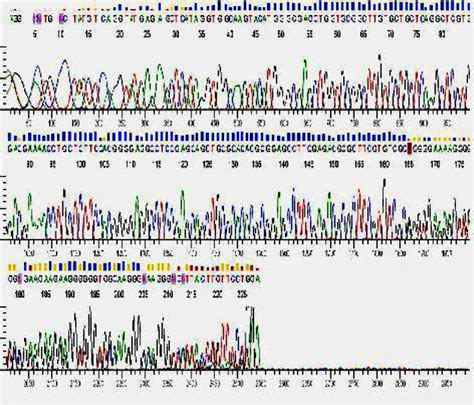 GCK Gene Mutation Analysis Of The Patient Showing A Heterozygous Single