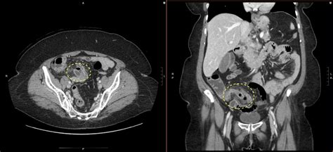 Abdominal Imaging Call Prep Cases P E R F O R A T E D A P P E N D I C