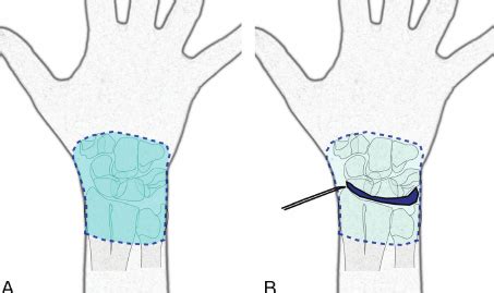 Schematic Illustration Of The In Fi Ltration Anesthesia Used For