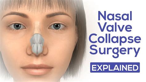 Nasal Valve Collapse Surgery Explained Dr Moustafa Mourad