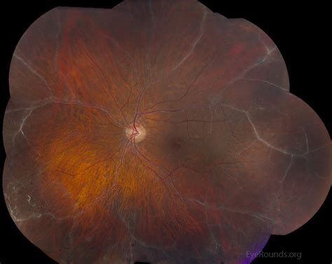 Atlas Entry Vascular Sheathing In Idiopathic Retinal Vasculitis