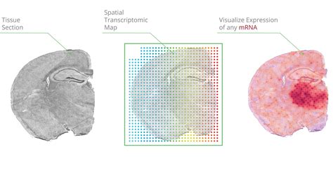 Spatial Sequencing Drives New Findings On Leprosy