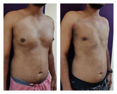 Gynaecomastia Surgery Cost In Bangalore, India | Best Gynecomastia ...