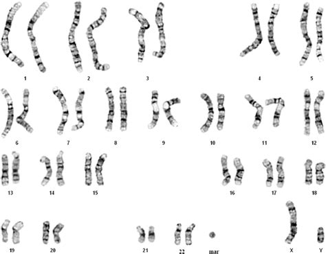 A Karyotype Of 47xyþmar Mar ¼ Marker Chromosome Download