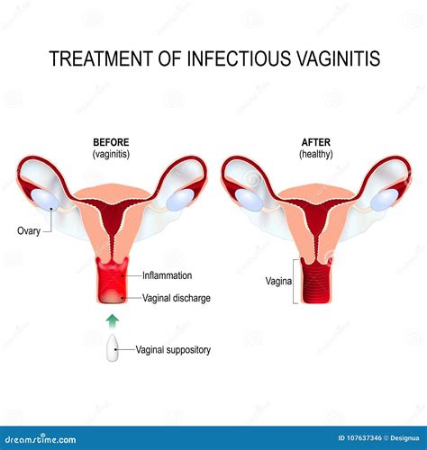 Treatment Of Infectious Vaginitis Stock Vector Illustration Of