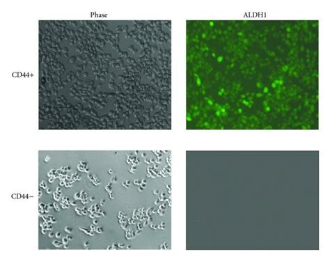 Correlation Of Cd44 And Aldh1 Expression In Epithelial Ovarian Cancer