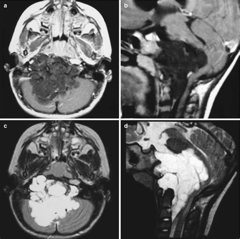 Postoperative Vertebral Column Complications | Neupsy Key