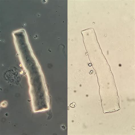 Classically Smooth Waxy Cast In A Patient With Aki 3 Urinarysediment