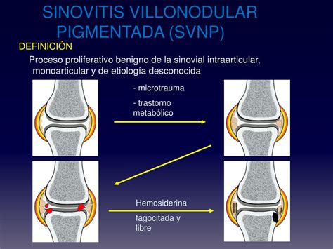 Ppt Malignizaci N De Sinovitis Villonodular Pigmentada A