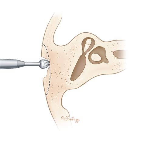 Mastoidectomy – Oto Surgery Atlas