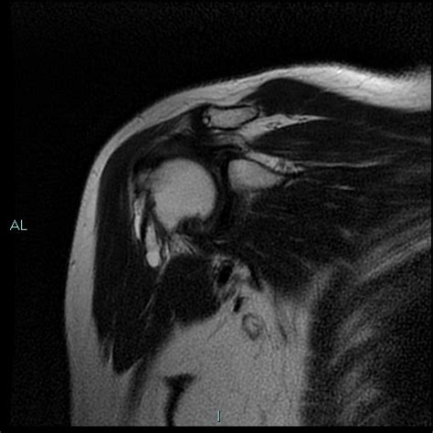 Intratendinous Ganglion Cyst Of Long Head Biceps Image