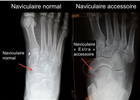 Anatomie Des Os Du Pied Radiographie Hallux Rigidus Docteur Benoît