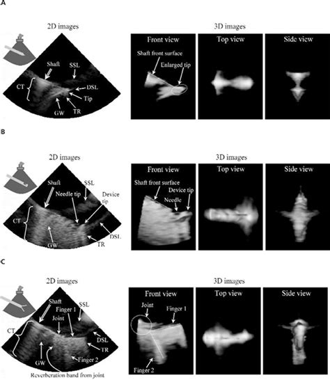 Imaging Artifacts Of Medical Instruments In Ultrasound‐guided Interventions Huang 2007