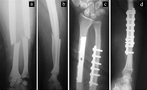 A B Immediate Post Trauma Radiograph With AP And Lateral View