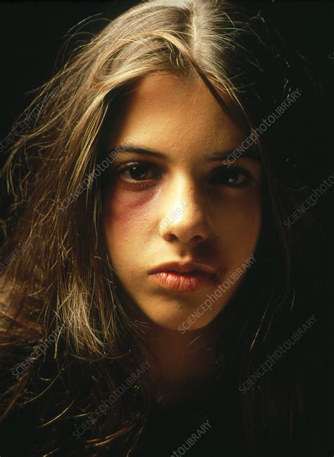 Teenage Girl With A Black Eye And Facial Bruising Stock Image M330