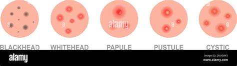 Nodular Acne Vs Cystic Acne