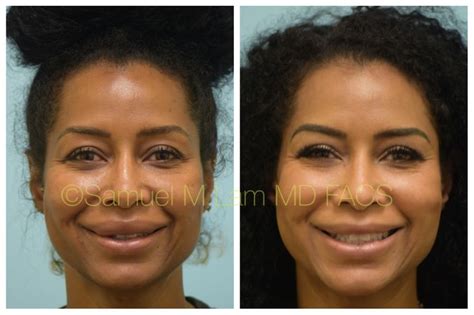 Pin On African American Lip Reduction