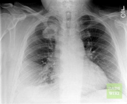 Osteochondroma | Radiology Reference Article | Radiopaedia.org