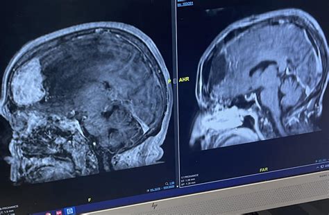 Mri Of Grade 2 Meningioma Before And After Bifrontal Craniotomy For